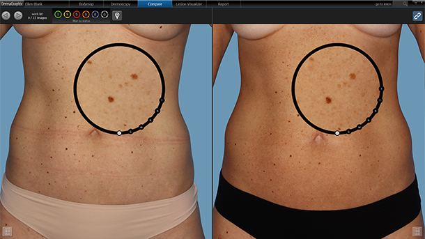 Lesion changes being displayed automatically via DermaGraphix