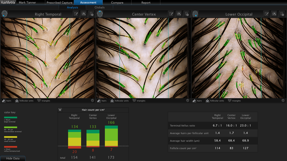 AI-powered HairMetrix displaying a quantitative hair analysis, comparing hair density and follicular units