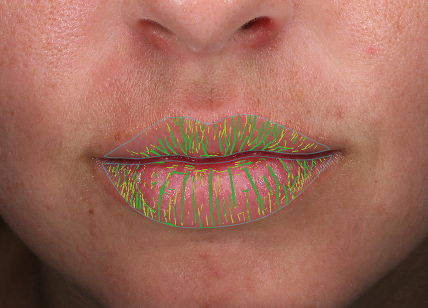 AI Driven Lip Assessment