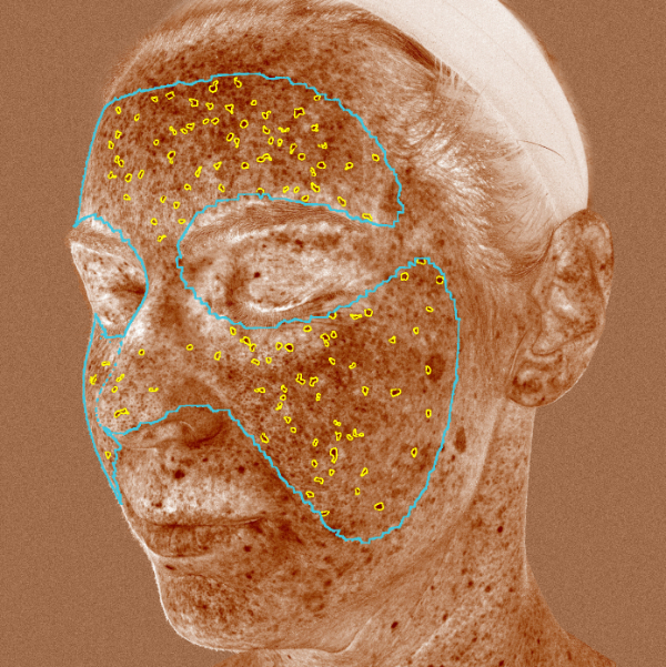 Advanced Skin Analysis - Brown Spots