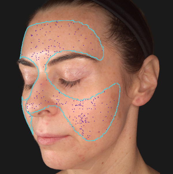 Advanced Skin Analysis - Pores