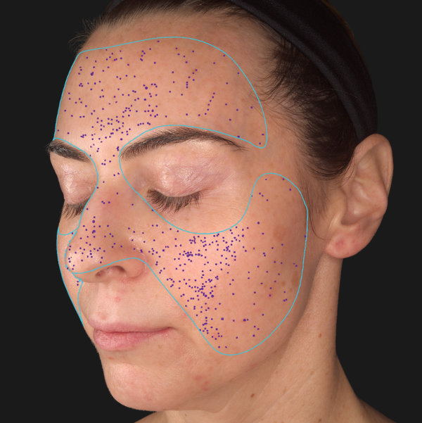 Advanced Skin Analysis - Pores