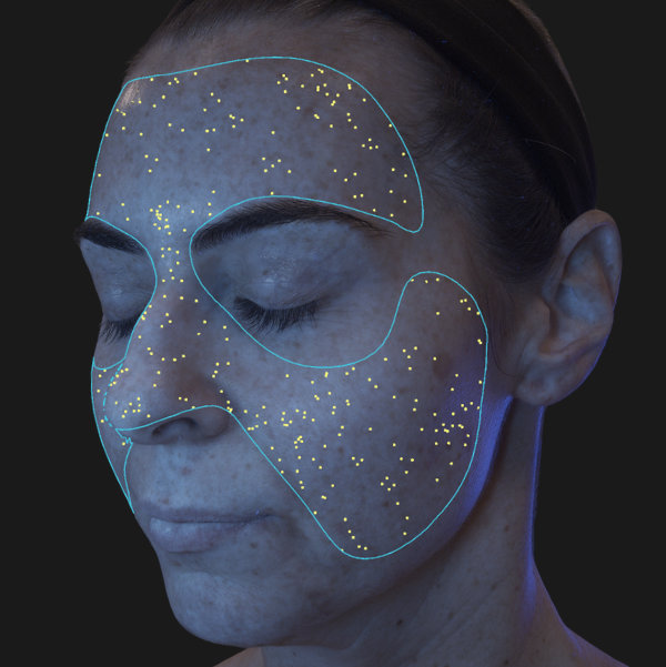 Advanced Skin Analysis - Porphyrins