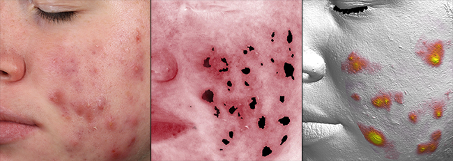 VISIA CR visualizing acne and offering objective assessments