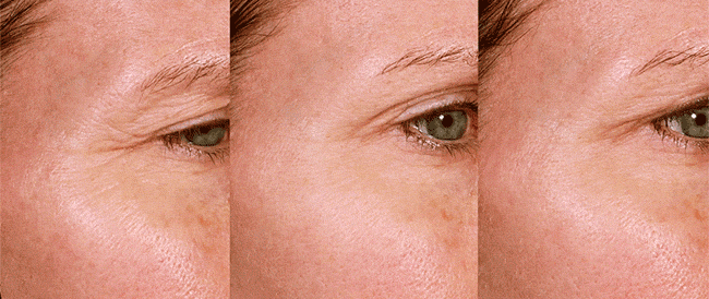 Skin movement and surface area reduction visible in color using markerless tracking algorithms