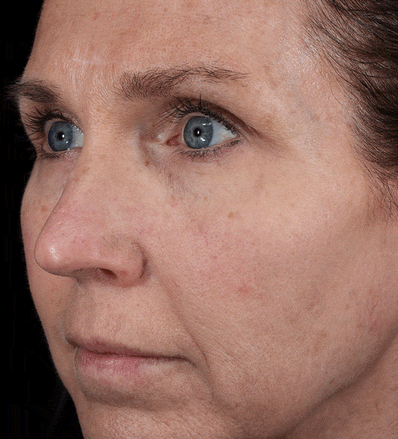 A person's face under 7 different lighting modes under one fast capture sequence by VISIA CR