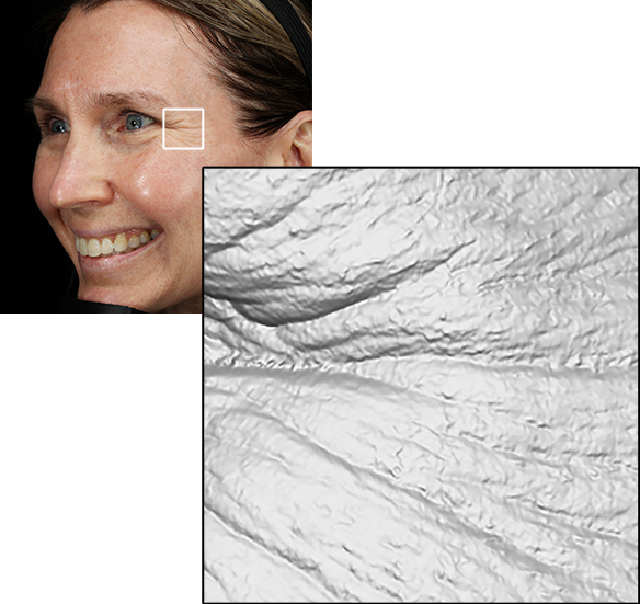 VISIA CR showing the pre- and post-treatment skin tonography of a patient under standard lighting and PRIMOS 3D