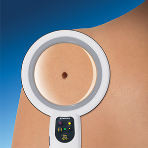 Optima magnifying a small lesion on a patient's back